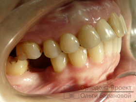 брекеты Инкогнито на зубах вид справа