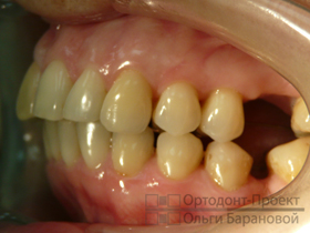 брекеты Инкогнито на зубах вид слева