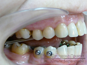 ортоэластики на зубах вид справа