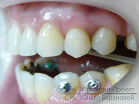 ортоэластики на зубах вид слева