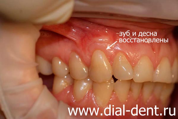 лечение рецессии десны и клиновидного дефекта зуба окончено