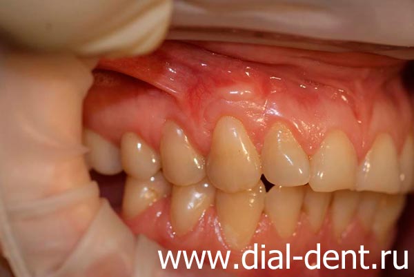 лечение рецессии десны и клиновидного дефекта зуба окончено