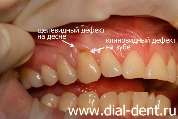 рецессия десны и клиновидный дефект зуба