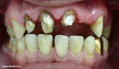 фото до лечения зубов