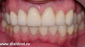 протезирование зубов - 2 года спустя