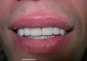 протезирование зубов завершено - красивая улыбка