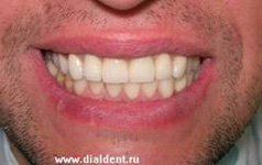 улыбка пациента два года после протезирование зубов