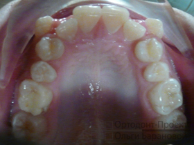 верхние зубы до лечения брекетами - скученность передних зубов, выпирают клыки