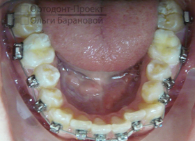 нижние зубы до лечения брекетами - скученность передних зубов