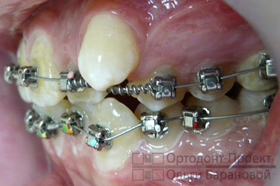 верхние зубы до лечения брекетами - скученность передних зубов, выпирают клыки