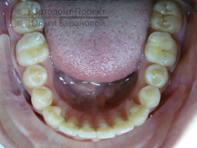 нижние зубы после лечения брекетами