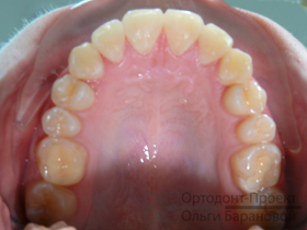 верхние зубы после лечения брекетами