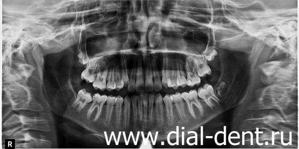 панорамный снимок зубов до ортодонтического лечения