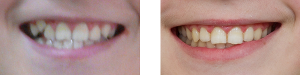 улыбка до и после ортодонтического лечения