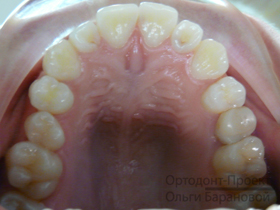 верхние зубы после комплексного ортодонтического лечения