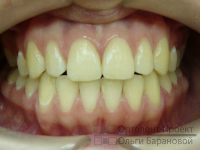 результат ортодонтического лечения - исправлен прикус, выровнены зубы