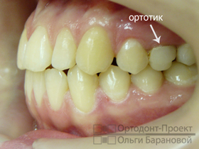 вид слева после комплексного ортодонтического лечения