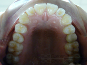 верхние зубы после снятия брекетов