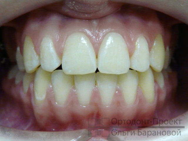 вид зубов после снятия брекетов