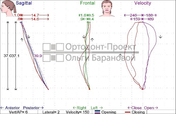 траектория движения нижней челюсти после лечения