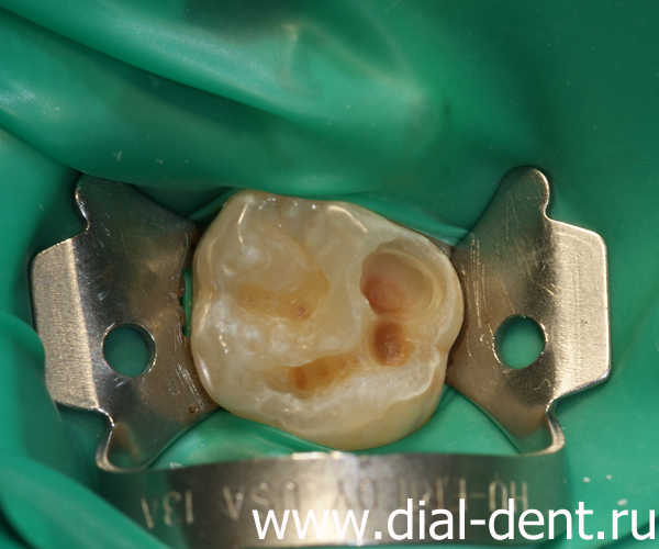 лечение кариеса зубов в Диал-Дент
