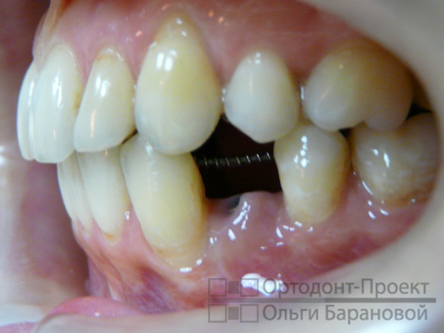 зубы выровнены, подготовлено место для установки зубного импланта