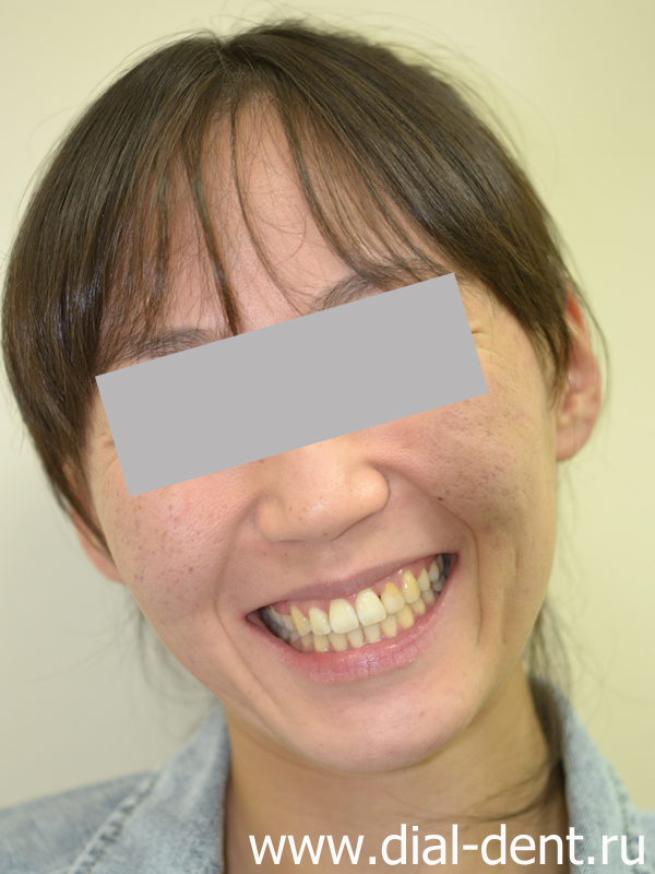 гармоничная улыбка после лечения у ортодонта