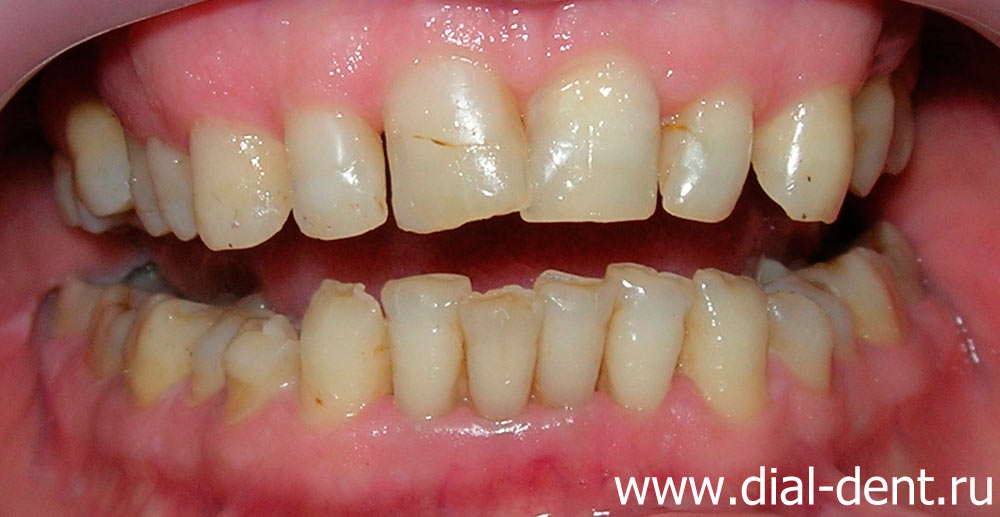 Передние зубы до лечения