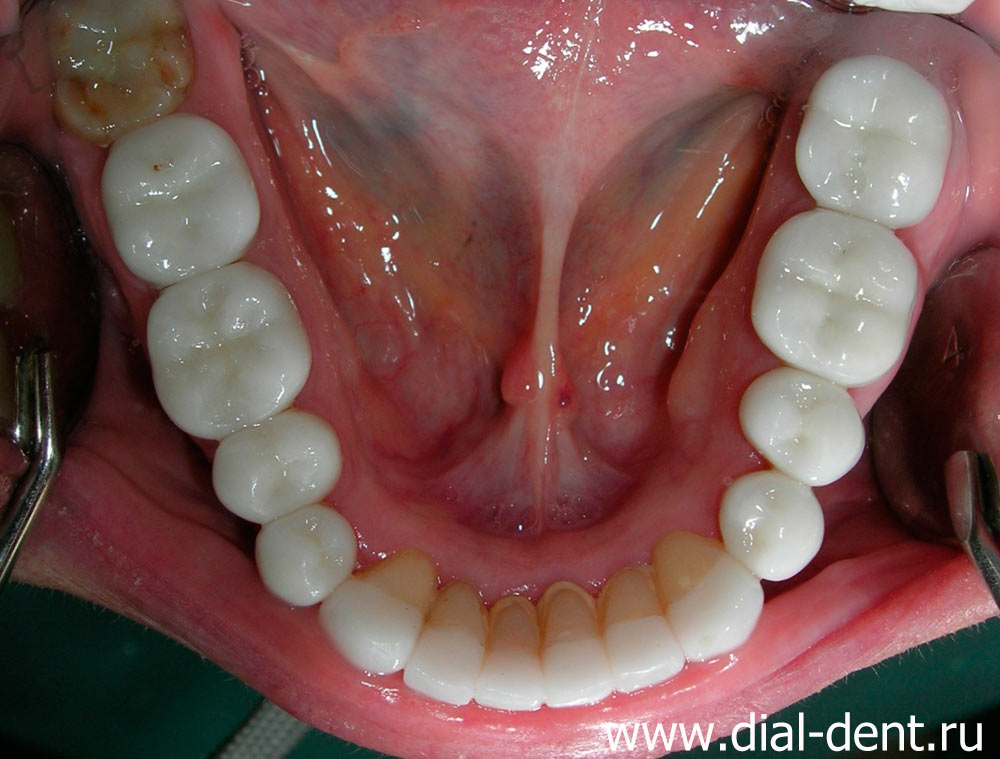Нижняя челюсть после лечения зубов
