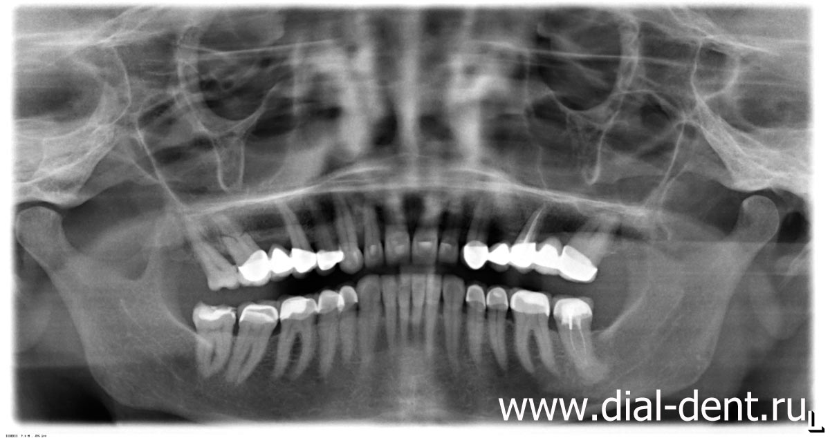 рентген челюсти пациентки