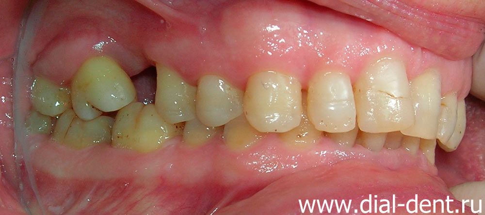 вид справа до лечения зубов