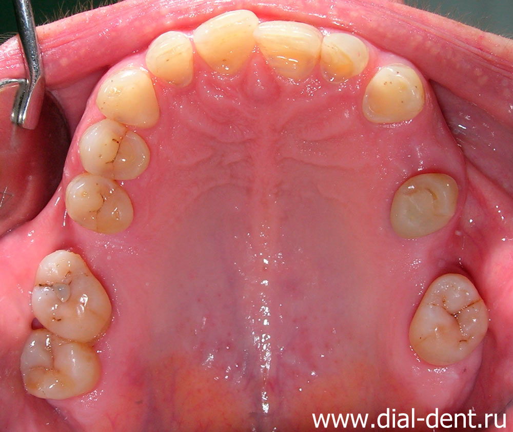 верхняя челюсть до лечения зубов