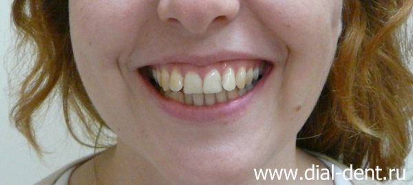 улыбка до ортодонтического лечения