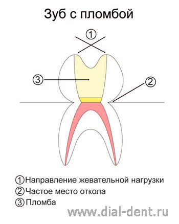 действие сил при восстановлении зуба пломбой