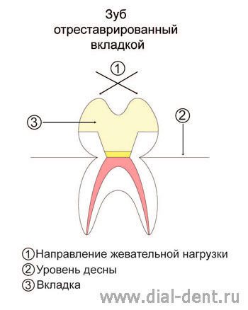 действие сил при восстановлении зуба вкладкой