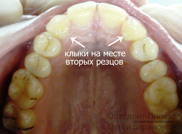 верхние зубы до ортодонтического лечения