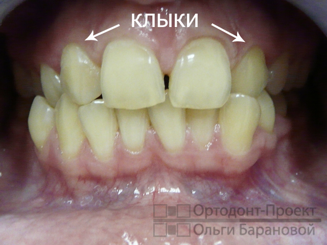 щель между зубами, отсутствие верхних вторых резцов, скученность зубов