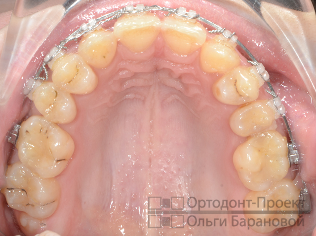 верхние зубы через 1 год и 6 месяцев от начала лечения