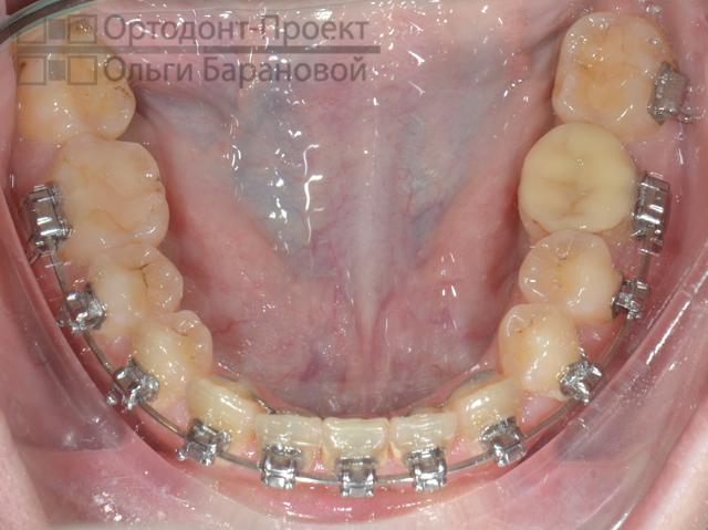 нижние зубы через 1 год и 6 месяцев от начала лечения