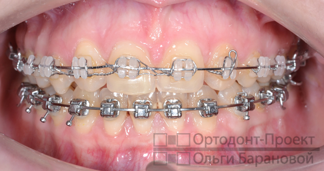 вид зубов через 1 год и 6 месяцев от начала лечения