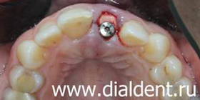 пластика десны при имплантации зубов