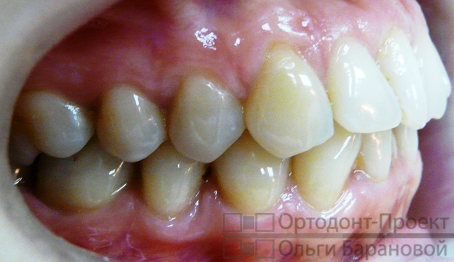 вид зубов справа до лечения у ортодонта