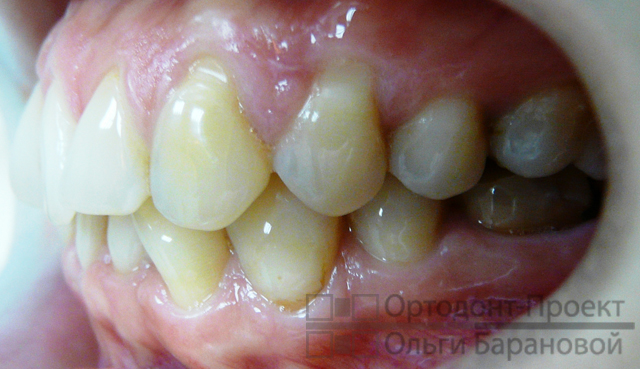 вид зубов слева до лечения у ортодонта