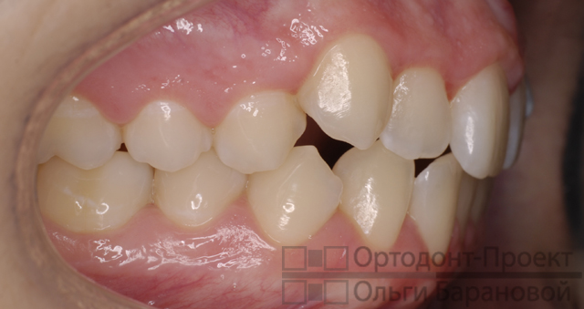 вид справа до ортодонтического лечения