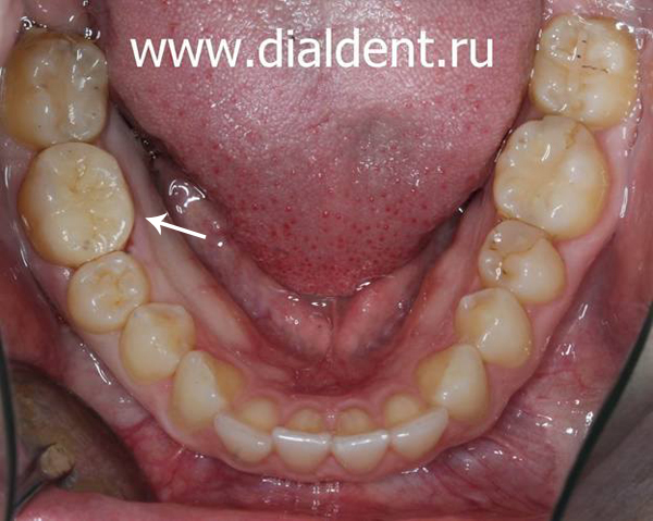 зуб восстановлен новой керамической вкладкой после лечения кариеса