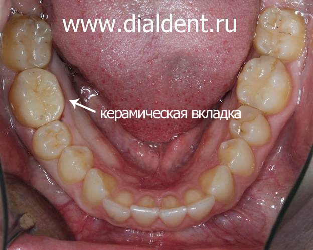 керамическая вкладка в зуб после лечения кариеса