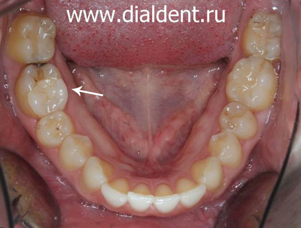 кариес на ранее (10 лет назад) депульпированном и восстановленном вкладкой зубе