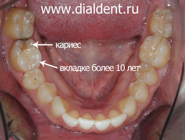 кариес на ранее (10 лет назад) депульпированном и восстановленном вкладкой зубе