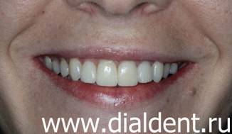 улыбка после комплексного лечения и реставрации зубов