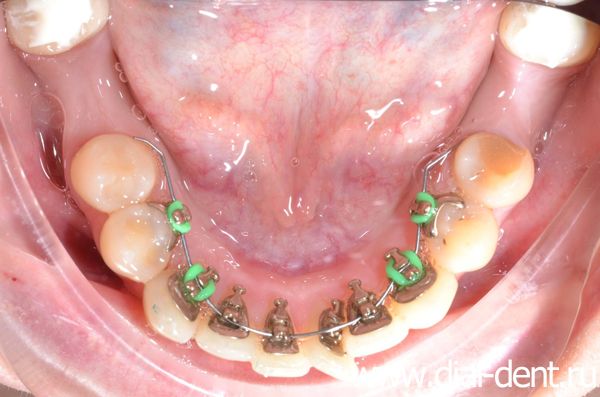 брекет-система Incognito Lite на нижних зубах